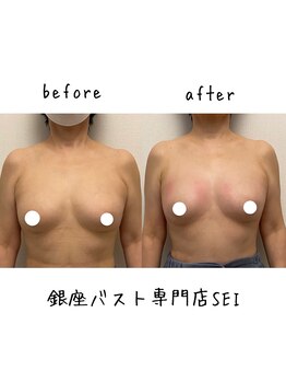 セイ(SEI)/B→A 下垂