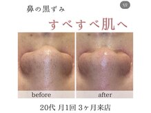 アネラ(Anela)/毛穴の黒ずみ。。