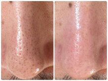 サイセイ(SAISEI)/毛穴汚れ放置していませんか？