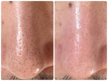 サイセイ(SAISEI)/毛穴汚れ放置していませんか?