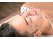 共立総合整骨院 八王子院/美容鍼は最近男性にも大人気！！