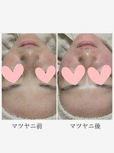 アメイジングボディーワクス(Amazing Body Works)/マツヤニパックビフォーアフター