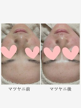 アメイジングボディーワクス(Amazing Body Works)/マツヤニパックビフォーアフター