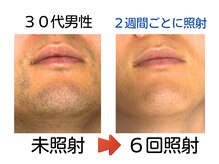 エビアス 旭川豊岡(evias)/メンズ店 6回でヒゲがこんなに！