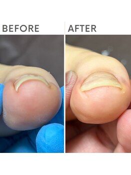 クオッカ(Quokka)/巻き爪ケア