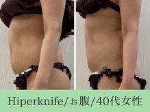 ソルニス(Solnis.)/痩身☆脂肪分解/ハイパーナイフ