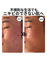 マヴィ(Ma vie)/ニキビ改善