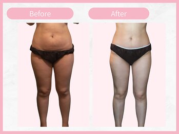 RHB東戸塚/痩身エステはRHB東戸塚