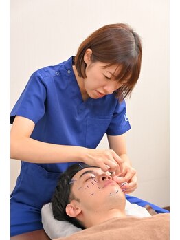 共立総合整骨院 八王子院/美容鍼は最近男性にも大人気!!