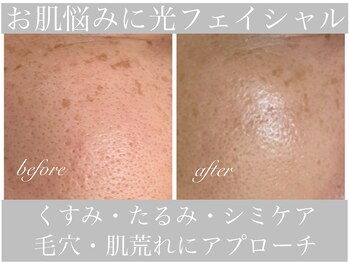 アリスビューティー(AliceBeauty)/シミ・くすみ・肌荒れケア◎