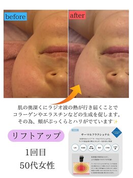 ユフラ(Juhla)/引き締め ほうれい線 ハリ