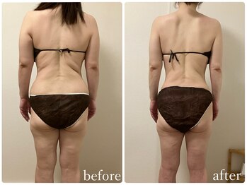 リリィブラン(Lily branc)/痩身/ダイエット