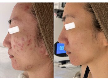 美時雨の写真/諦めていた肌荒れにさよなら!長年の悩みを解消する完全オーダーメイドプログラムで輝く素肌を実感♪