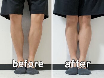 サンク(Cinq)/【O脚矯正+骨格矯正】O脚改善