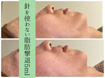 ソルニスデュオ(Solnis.-duo-)/小顔/酵素浴/ハイパーナイフEX2