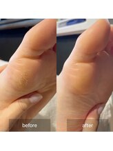 アイル(isle)/【硬い角質でお悩み】のお客様