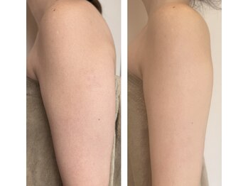 アドビューティ(Add Beauty)/花嫁様プラン／ブライダルエステ