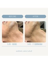 レブル(Lebull)/ヒゲ脱毛途中経過