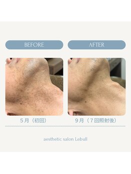 レブル(Lebull)/ヒゲ脱毛途中経過