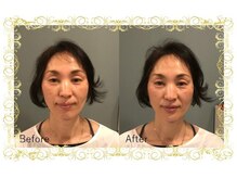 レメディ/美容鍼スペシャルコース