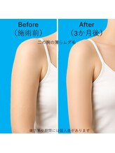 ブロッサム(BLOSSOM)/ひじ上脱毛