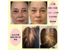 ベルシック(Belchic)の雰囲気（プラズマ搭載でより即効性と持続性をシワたるみ改善/AGA対策に）