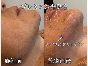 MMA/プレミアム光脱毛【ひげ】