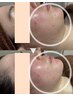 速攻小顔【Eライン造形/たるみ/二重あご】リフトアップ脂肪燃剤導入
