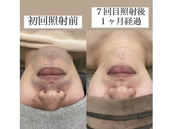 テンパ ビューティー(+10%beauty)/効果写真