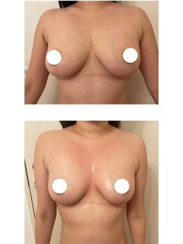 ソラ(SORA)/バストアップ症例