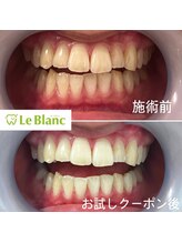 ルブラン 奈良店(Le Blanc)/成人式までに歯を白く！