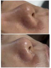 アロラヴィ(AroRavi)/毛穴徹底プログラム