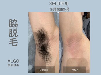 アルゴ 山口宇部店(ALGO)/即日!脇脱毛+WAX