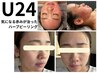 U24限定｜赤みニキビに悩む24歳以下へ☆初めてのハーブピーリング