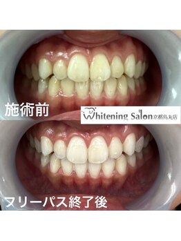 ホワイトニングサロン 京都烏丸店/ホワイトニング施術例