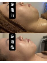 フェミニー(Feminy)/【小顔整顔リフト】もたつき顎下