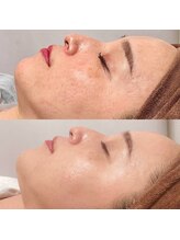 アースコアフュールボーテ 小山店(EARTH coiffure beaute)/ハーブピーリング