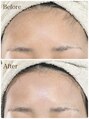 クーイー ジリーアイ(cooey. gillyeye)&nbsp;うぶ毛をなくして、つるんと艶玉肌に。