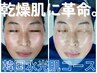 【モニター1日3名様限定】乾燥肌に革命。水分爆弾パック《韓国水光肌コース》
