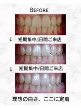 エミリアホワイトニング(EMIRIA WHITENING)/Before/After
