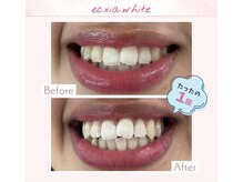 エクシアホワイトニング 調布店/40代女性会員様/1回目