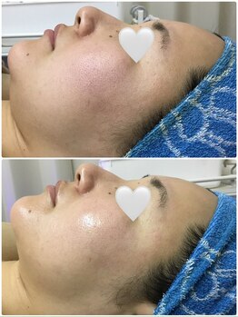 リムーブラボ 藤岡店(Remove Lab.)/口コミ高評価☆ハーブピーリング