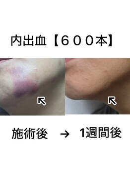 プレシャスワン 越谷店/内出血 美容鍼600本施術後