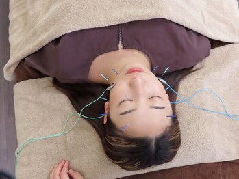 ゆしんアネックスの写真/【小顔・むくみ・たるみ・くすみ改善に◎】リフトアップ美容鍼30分 ￥13,960 → 初回限定￥4,980