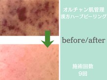 ウィア スキンサロン(Uvia skin salonk)/ニキビケア・にきびケア/柏駅