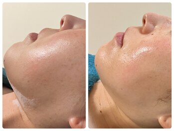 グラン ジュテの写真/効果はレモンボトルレッドショット以上！脂肪分解液【リポベラ】はじめました。顔だけでなく体にも○