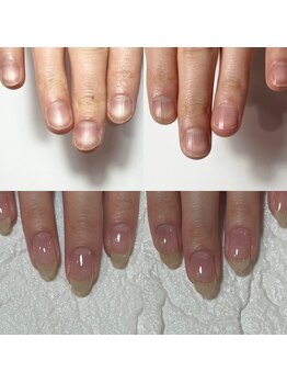 セラキュアネイル(Theracure nail)/自爪育成で健康な爪にしましょう