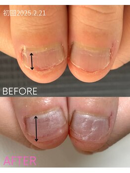 シーグラス(SeaGlass)/噛み爪育成+ハンドマッサージ付