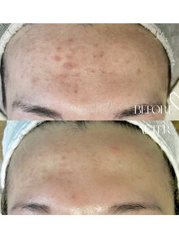 #美容革命ラボ 大阪南堀江店/艶肌ハーブピーリング/梅田難波