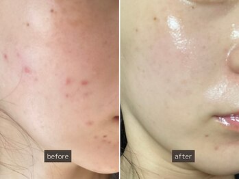 SEC(Shizuoka esthetic company)/【ニキビケア】本気の肌質改善